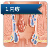 內(nèi)痔