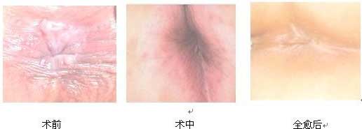 微(wēi)創術(shù)治療