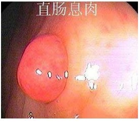 直腸息肉