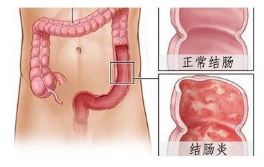 結腸炎