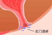 肛門(mén)濕疹