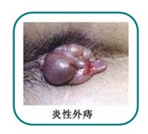 炎性外(wài)痔籃筐
