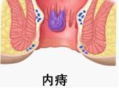 內(nèi)痔
