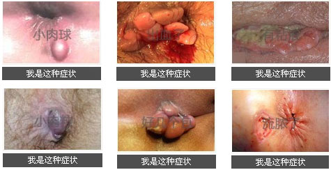 屁股長(cháng)包、疙瘩、痘痘