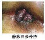 靜(jìng)脈曲張外(wài)痔