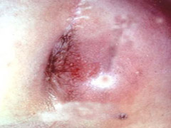 肛門(mén)灼熱(rè)