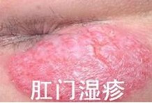 肛門(mén)濕疹