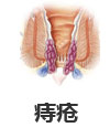痔瘡