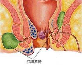 高(gāo)位肛周膿腫